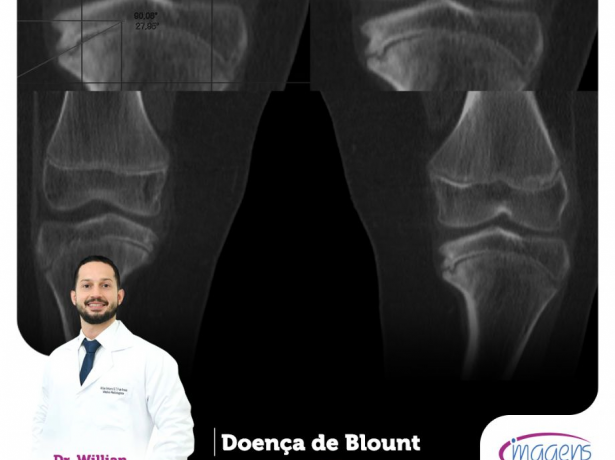 Doença de Blount | Dica do Especialista - Imagens - Medicina Diagnóstica
